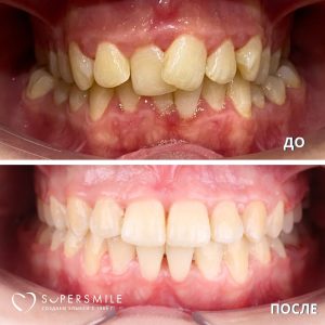 Исправление скученности зубов