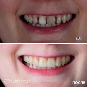 Комплексный план лечения (до/после)