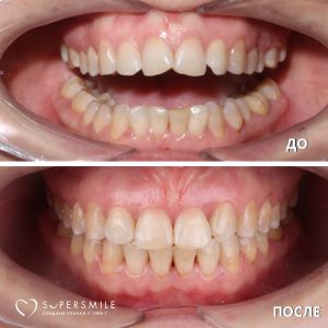 Исправление прикуса (до/после)