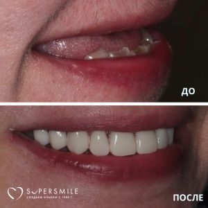 До/После №12673