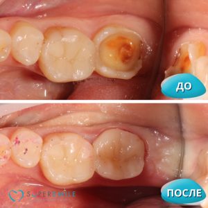 Керамическая накладка (до/после)