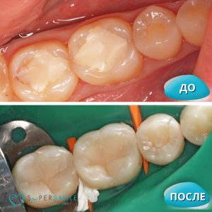 Лечение кариеса (до/после)