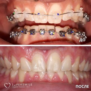 Исправление прикуса (до/после)