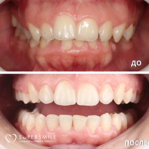 Случай пациента с дистальным глубоким прикусом и неровными зубами