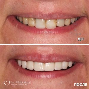 Протезирование зубов (до/после)